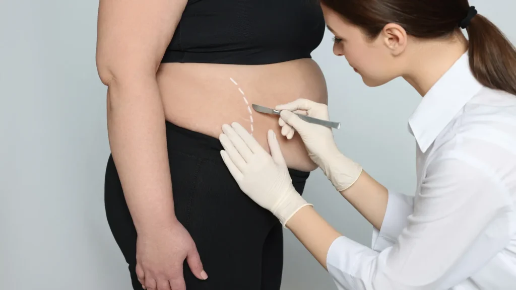 Cost of Gastric Sleeve Surgery