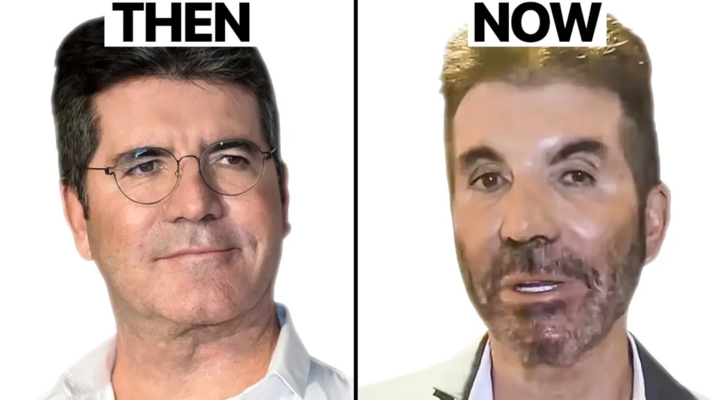 Simon Cowell Plastic Surgery