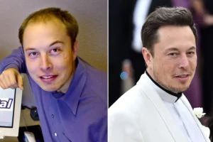 Elon Musk Hair Transplantation